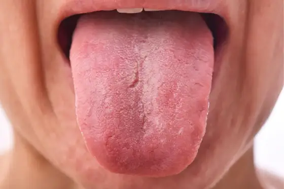 Lengua blanca por clorhexidina - ¿Qué significa realmente?