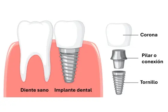 Tornillo dental - ¿Implante, pilar o corona? Guía completa