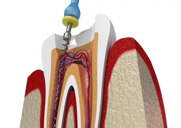 Procedimiento dental para tratar una muela picada, mostrando la limpieza del conducto radicular con una lima.
