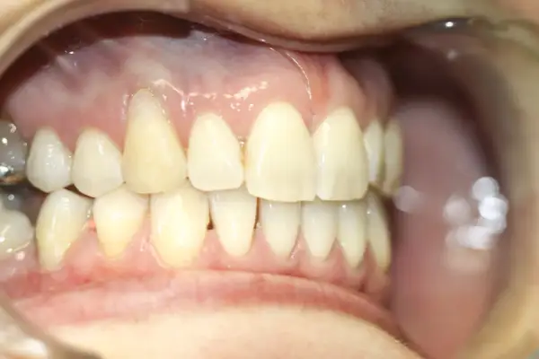 Dientes sanos y encías rosadas, sin signos de poner encías retraídas.