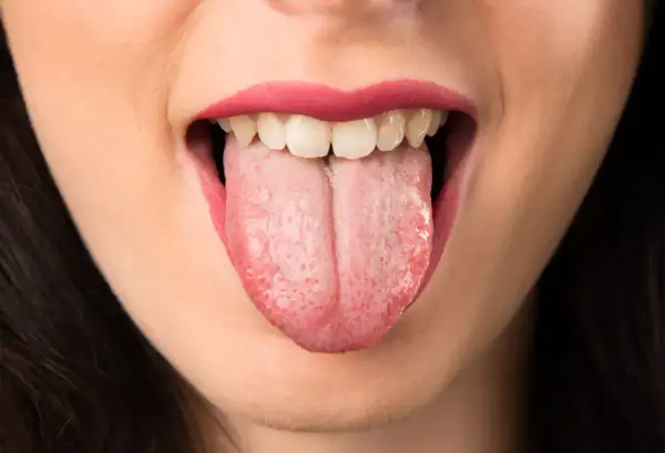 Boca abierta mostrando lengua rosada con pequeñas manchas rojas, reflejo de la ansiedad en la boca.