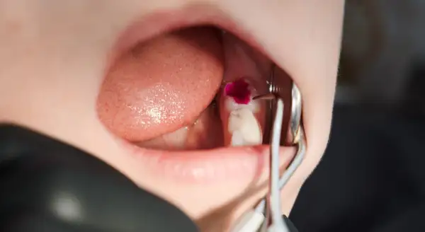 Detalles de cómo se limpia una caries con un tinte revelador y herramientas dentales.