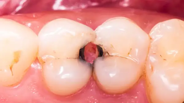 Caries severa en la arcada dental inferior, con cavidades profundas entre los dientes.