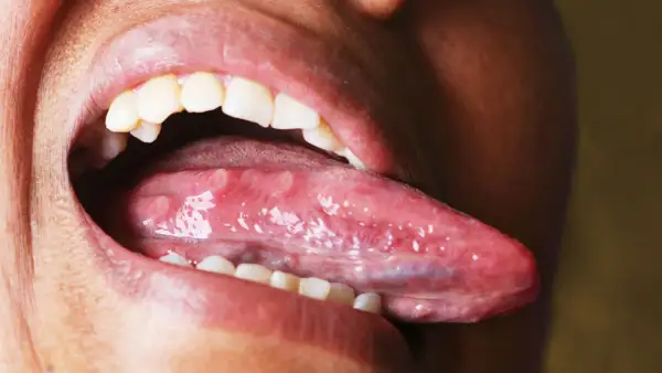 Boca abierta mostrando la lengua con múltiples llagas blancas y rojas, una llaga en la lengua que no se cura.
