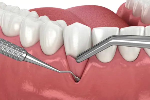Ilustración dental que muestra el inicio de un trasplante de encía, con instrumentos quirúrgicos listos para el procedimiento.
