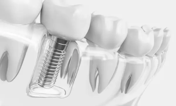 Detalle de implantes dentales tornillos, mostrando su integración en el hueso y la corona dental.