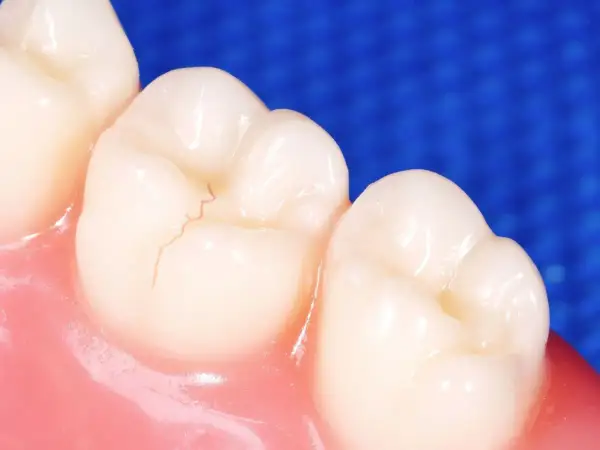Detalle de una muela con una fisura fina. Aprende como arreglar una fisura en la muela para mantener tu sonrisa sana.