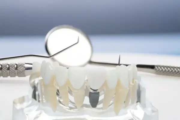 Modelo dental con implantes osteointegrados, mostrando la integración de un implante en la mandíbula, junto a herramientas dentales.
