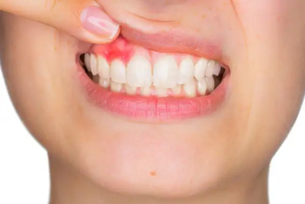 Encía inflamada y enrojecida, mostrando un posible flemón sin dolor. Dientes blancos y sanos.