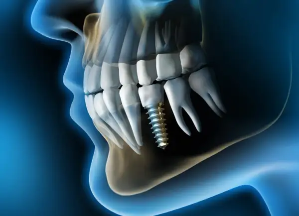 Implante dental en el hueso maxilofacial, mostrando la estructura ósea y los dientes.