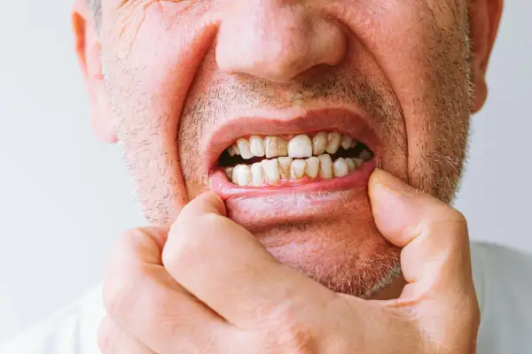 Primer plano de la boca de un hombre, mostrando un diente roto y otros dientes desgastados.