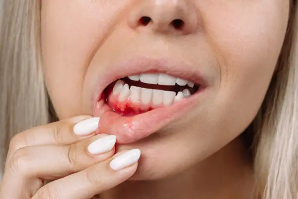 Una persona se toca la encía inflamada y con sangrado dental, mostrando los dientes blancos.