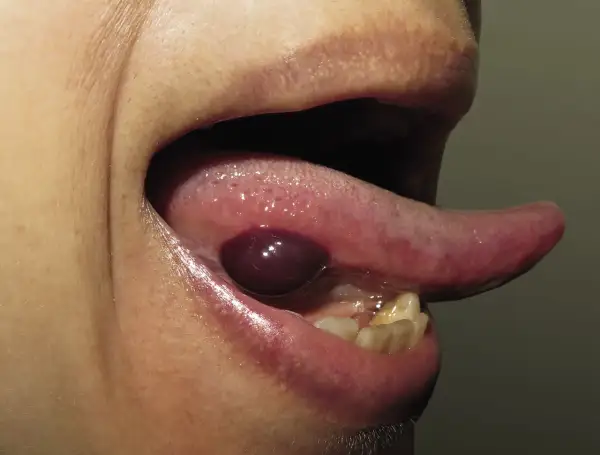 Ampolla oscura y abultada debajo de la lengua, con la lengua extendida.