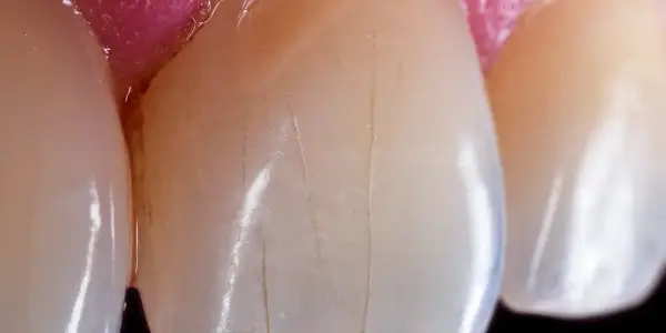 Detalle de dientes con finas líneas verticales que sugieren una infracción del esmalte.