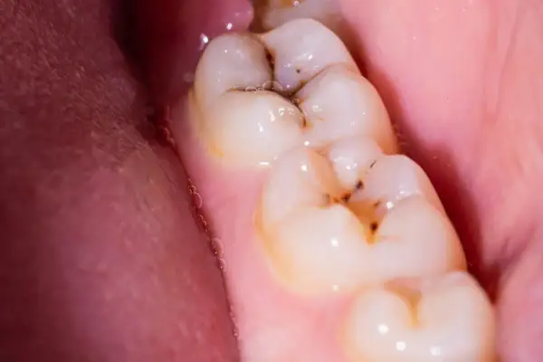 Muelas con caries y empastes. Se observa una muela picada con restos de comida y un empaste dental.