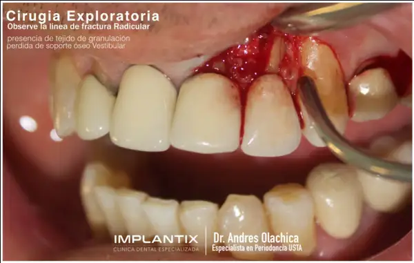 Exploración dental muestra una fractura radicular con tejido de granulación y pérdida ósea vestibular.