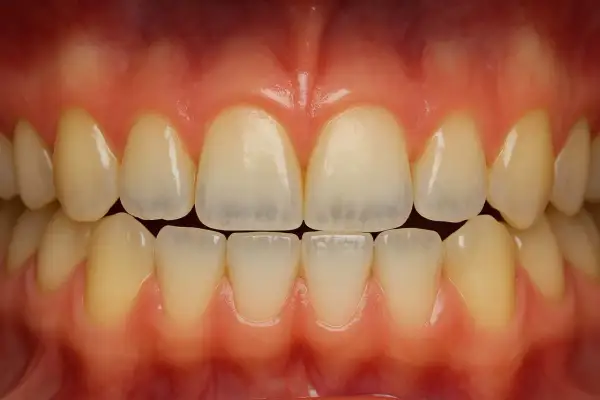 Vista frontal de una boca con dientes sanos y encías rosadas. Se aprecian los incisivos y caninos superiores e inferiores, mostrando una dentadura completa y sin signos de dientes porosos.