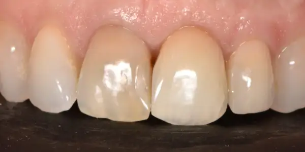 Primer plano de dientes frontales, uno de ellos muestra un diente delantero picado con una pequeña cavidad visible.