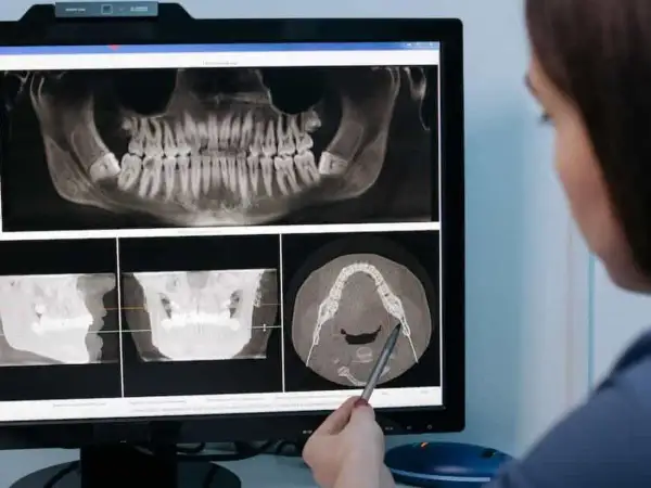 Dentista revisa radiografías dentales, incluyendo una vista panorámica y cortes transversales, para evaluar la necesidad de una elevación de seno maxilar que duele.