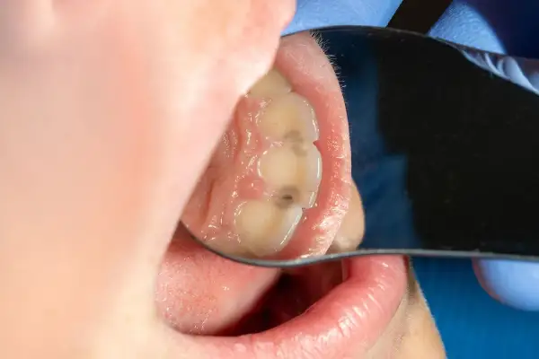 Vista de caras interproximales de los dientes, con caries visibles en algunas zonas.