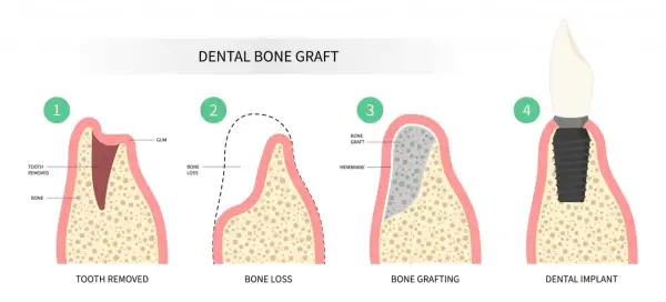Ilustración del proceso de injerto óseo dental: extracción, pérdida ósea, injerto y colocación de implante para recuperar hueso dental.