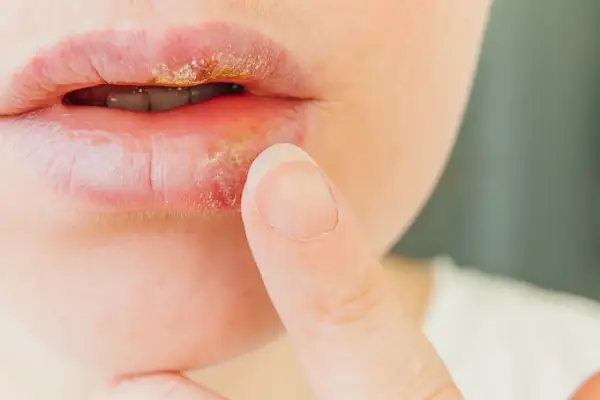 Labios con herpes, señal de defensas bajas. Una persona se toca el labio afectado.