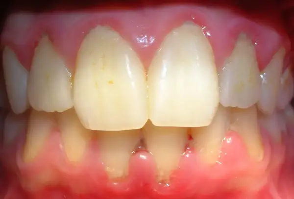 Encías inflamadas y enrojecidas, con signos de gingivitis por estrés. Se observan dientes con manchas y la línea de la encía retraída en algunas zonas.
