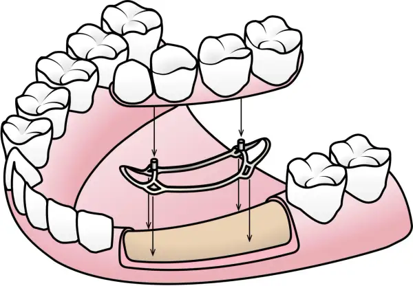 Si no tienes hueso para implante dental, una prótesis parcial removible como esta puede ser tu solución.