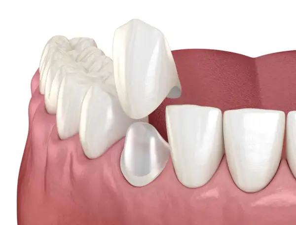 Coronas de disilicato de litio listas para ser colocadas en los dientes, mejorando la estética dental.