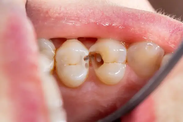 Vista de cerca de una muela con una caries visible. Se aprecian los dientes sanos y la cavidad oscura de la caries.