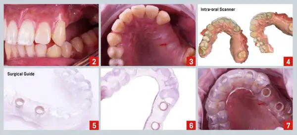 Guía quirúrgica para implantes dentales, planificando un puente dental en los dientes delanteros.