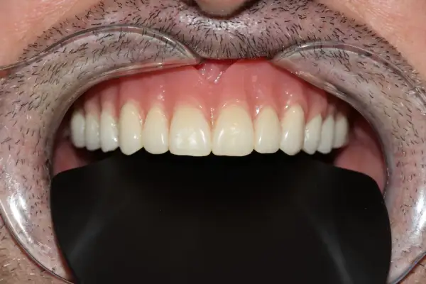 Una dentadura sin dientes, con encías rosadas y dientes postizos blancos y perfectos, se muestra en primer plano.