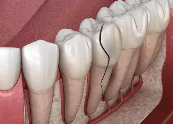 Dientes delanteros con grietas visibles, mostrando el daño en el esmalte y la pulpa.