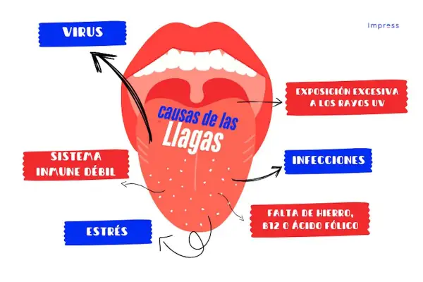 Ilustración de boca abierta mostrando la lengua con puntos, con flechas que señalan las ampollas en la boca causas: virus, sistema inmune débil, estrés, exposición UV, infecciones, falta de hierro/B12/ácido fólico.