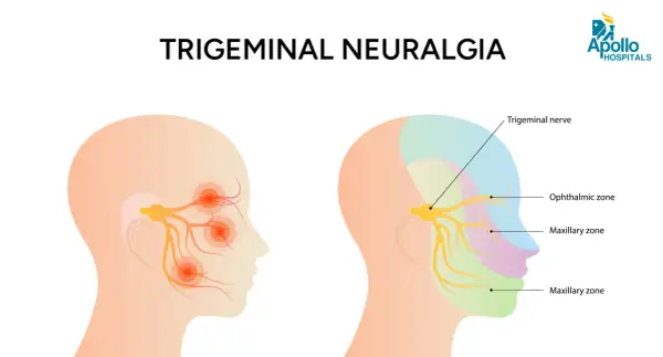 Ilustración muestra el nervio de la boca y sus zonas de afectación en la neuralgia trigeminal, con puntos de dolor en la cara.