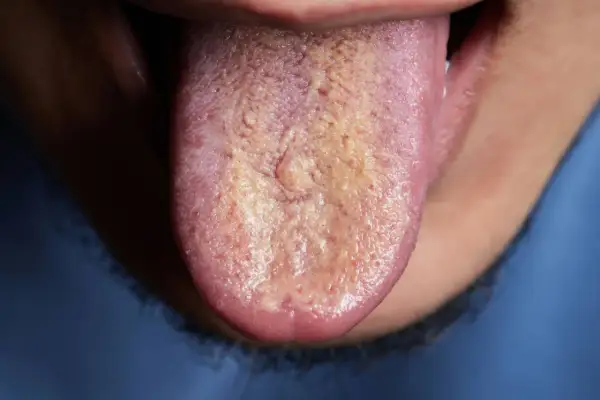 Lengua con capa blanquecina y amarillenta. ¿Cómo saber si me huele el aliento? Podría ser una señal.