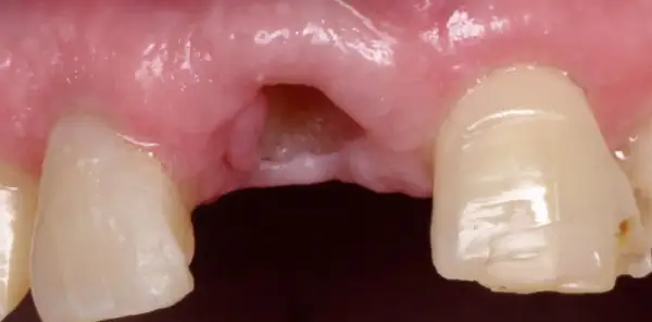 Gingiva con espacio desdentado y dientes adyacentes. Se observa la necesidad de limar diente astillado para mejorar la estética y función.
