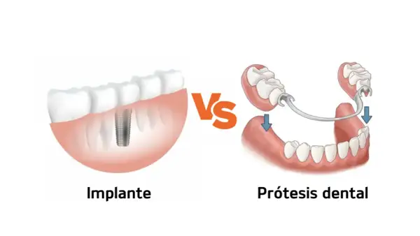 Comparación de implante dental y prótesis para solucionar la falta de dientes.